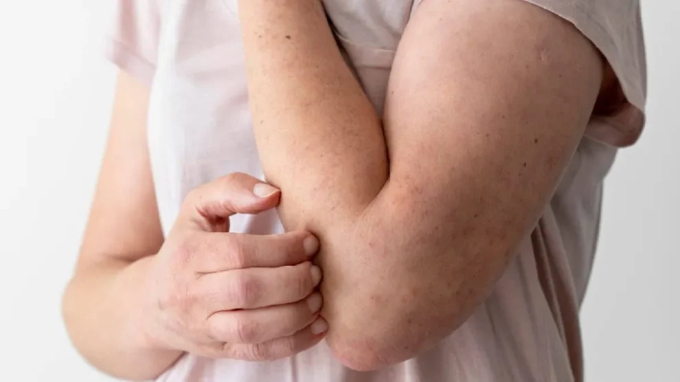 Campanha do Hospital das Clínicas da UFG sobre hanseníase reforça importância do combate ao estigma da doença